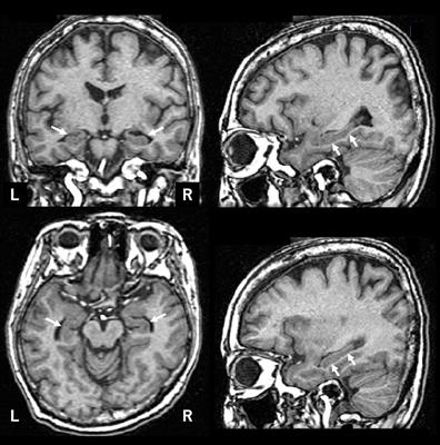 Machine Learning for Diagnosis of AD and Prediction of MCI Progression From Brain MRI Using Brain Anatomical Analysis Using Diffeomorphic Deformation